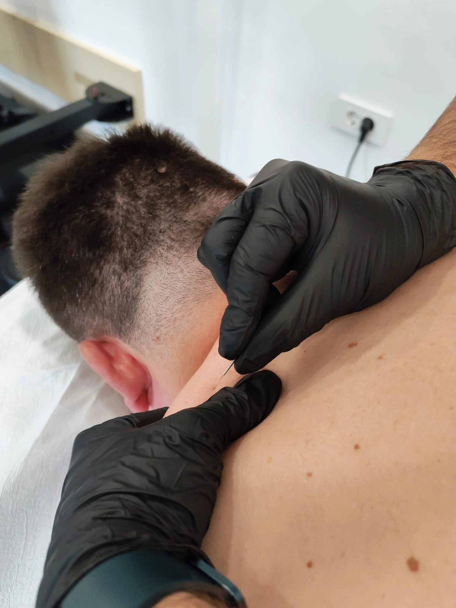 Dry needling